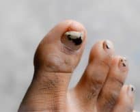 Other Benefits - Thick and crumbly toenails
